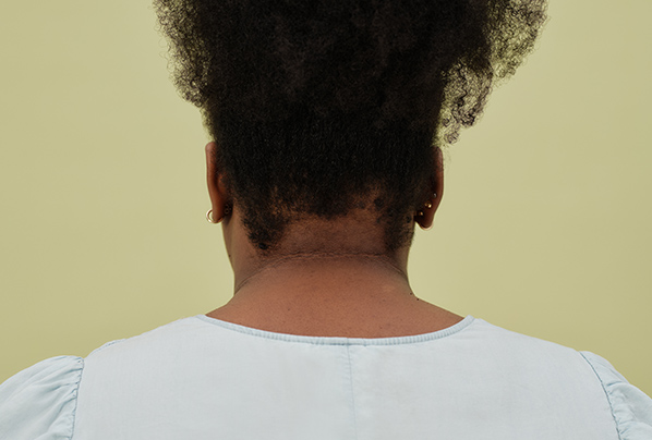 A woman of colour with eczem signs on the back of the hairline and neck