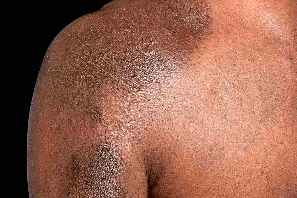 An image of a person's upper body showing physical signs of eczema
