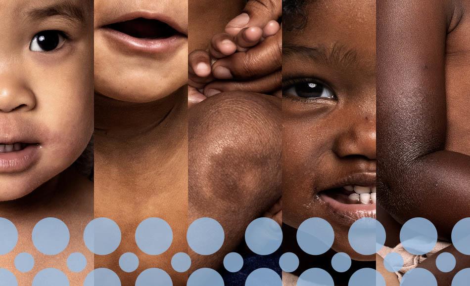 Five images of baby eczema on black skin