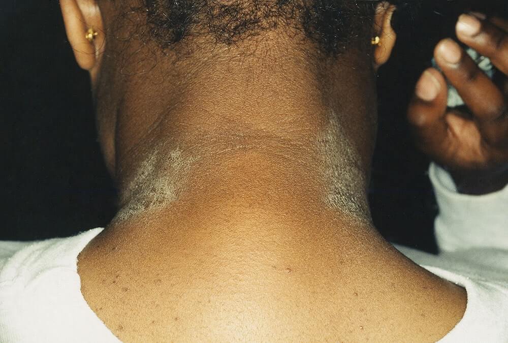 The back of a person's neck that shows signs of eczema