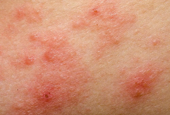 An image of skin with red patches showing signs of eczema