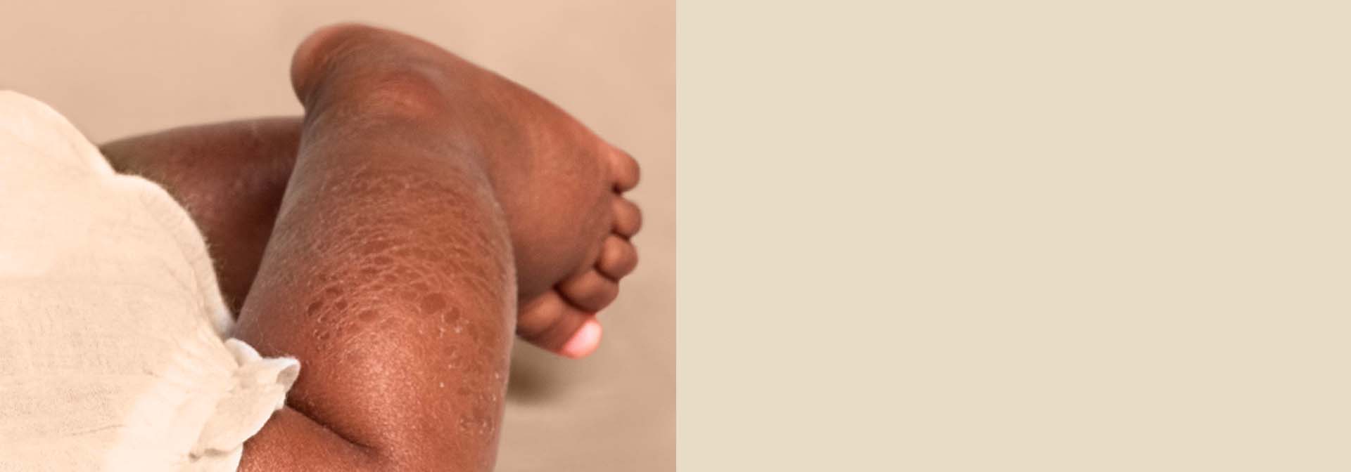 A baby’s lower leg showing signs of eczema