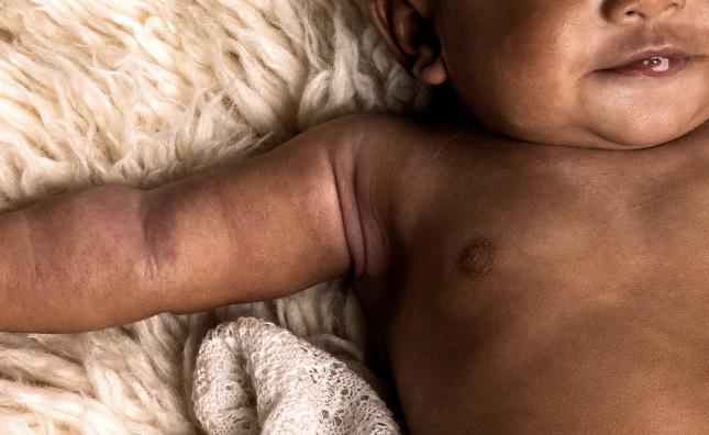 Eczema on a baby’s chest and arms