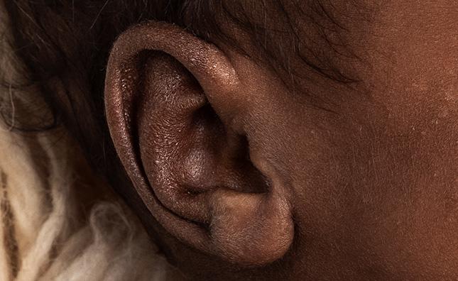 Signs of eczema on a baby’s ear