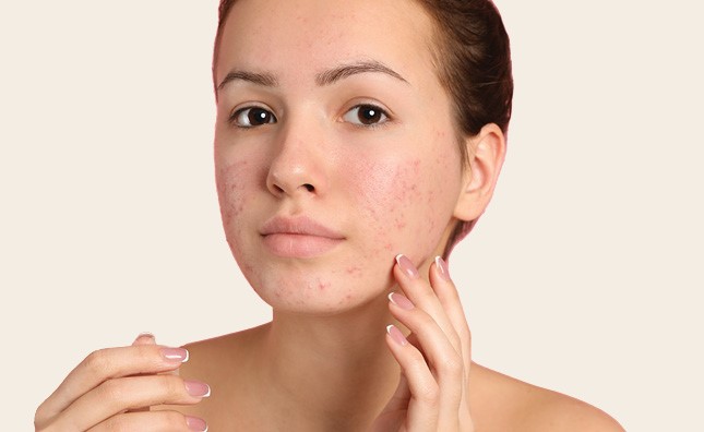 Woman with acne prone skin touching her face with one hand