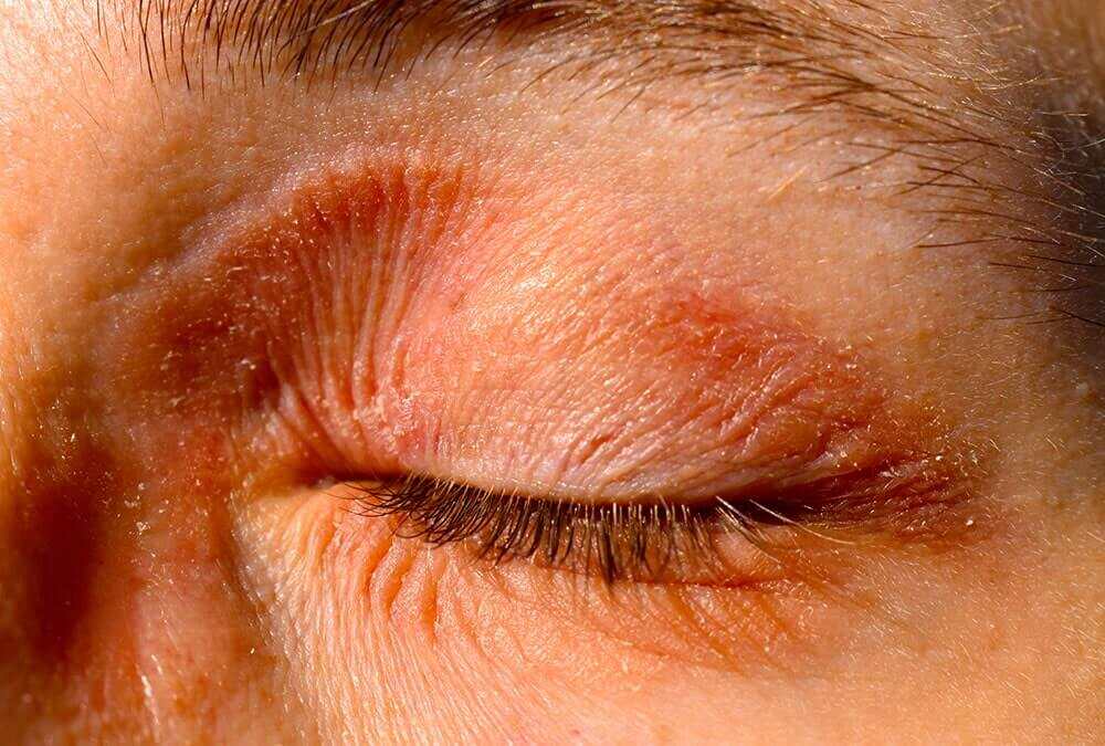 An eyelid exhibiting eczema signs