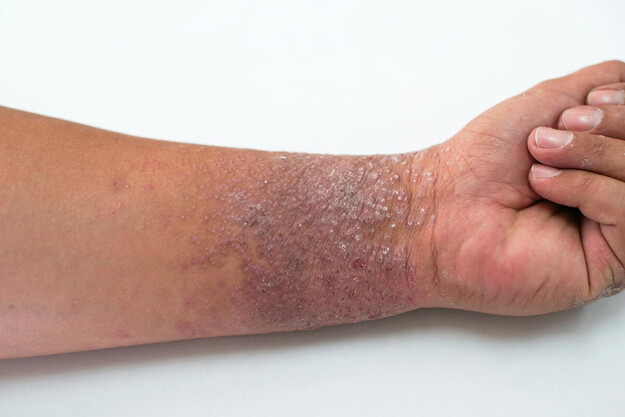 The underside of a wrist showing eczema signs