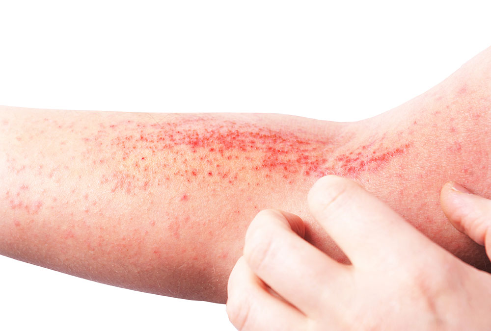 Forearm showing eczema signs with someone itching the red inflamed area